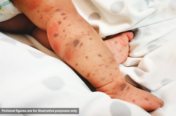 ไข้กาฬหลังแอ่น