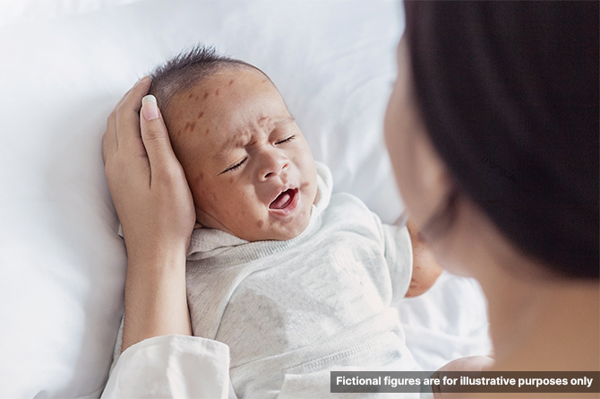 ไข้กาฬหลังแอ่น