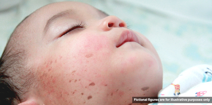 โรคไข้กาฬหลังแอ่น  แม้พบไม่บ่อย แต่อาจคร่าชีวิตได้ใน 24 ชั่วโมง