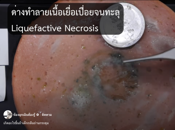 ลูกกลืนถ่านกระดุม