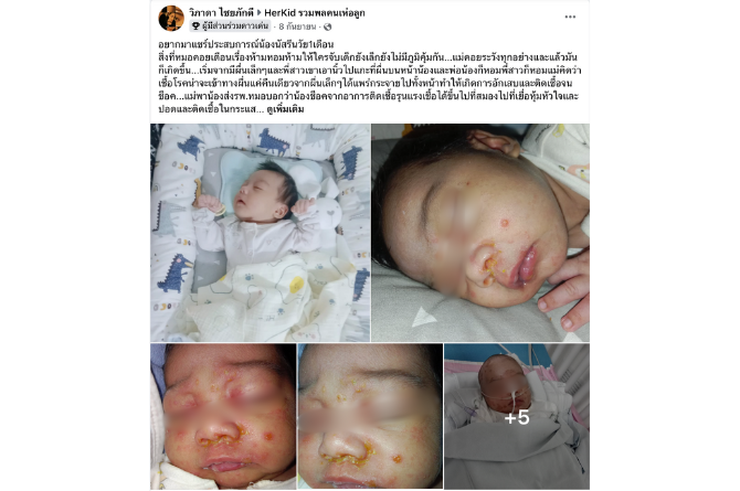 ลูกติดเชื้อจากการหอมแก้ม