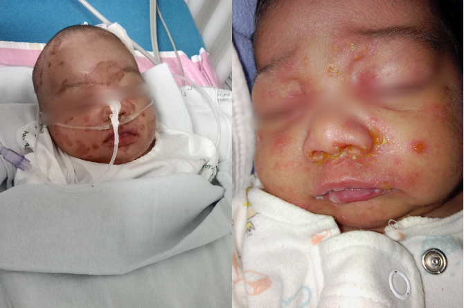 ลูกติดเชื้อจากการหอมแก้ม