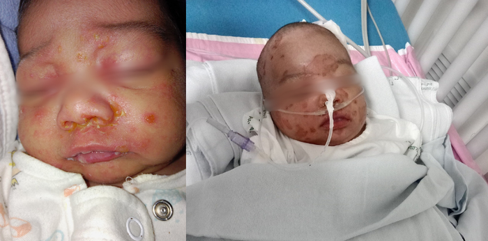 แม่โพสต์อุทาหรณ์ ลูกติดเชื้อจากการหอมแก้ม จนช็อค! ต้องเข้าไอซียู