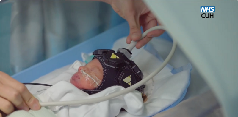 ครั้งแรกของโลก! หมวกสแกนสมองทารก รู้ทันความเสี่ยงตั้งแต่แรกคลอด