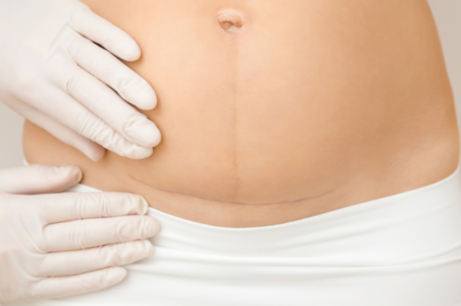 อาการผิดปกติของแผลผ่าคลอด