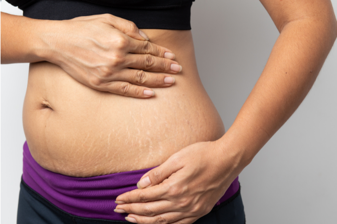 หน้าท้องแตกลาย