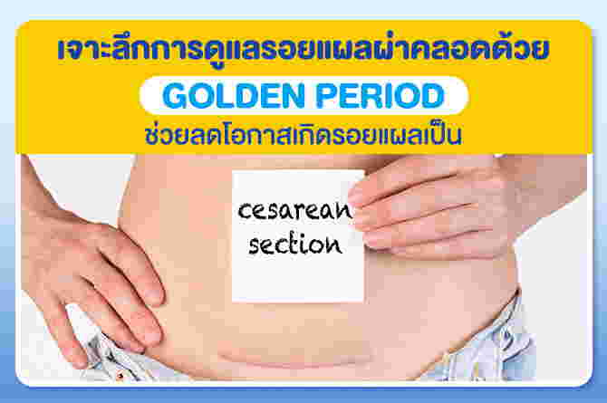 ดูแลแผลผ่าคลอด