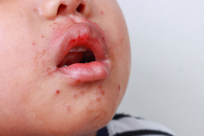 "โรคมือเท้าปาก" ระบาดหนักที่เวียดนาม