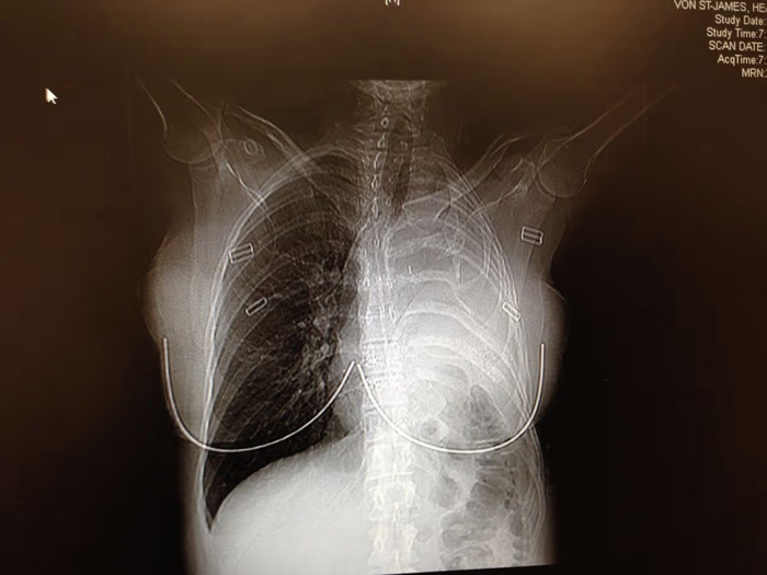 มะเร็งเยื่อหุ้มปอด