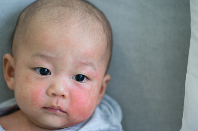 เด็กแพ้อาหาร