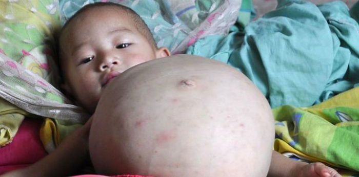 Pelik Tapi Benar, Bayi 2 Bulan Ini Didapati Mengandung! Apa Yang Terjadi?