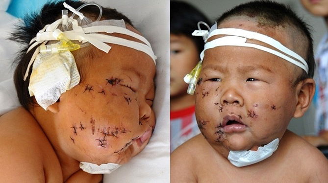 Sadis! Akibat Gigit Puting Ibu, Bayi 8 Bulan Ini Ditusuk 90 kali & Wajahnya Cedera Teruk!