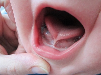Mengenal Tongue Tie Baby Yang Menyebabkan Bayi Susah Menyusu