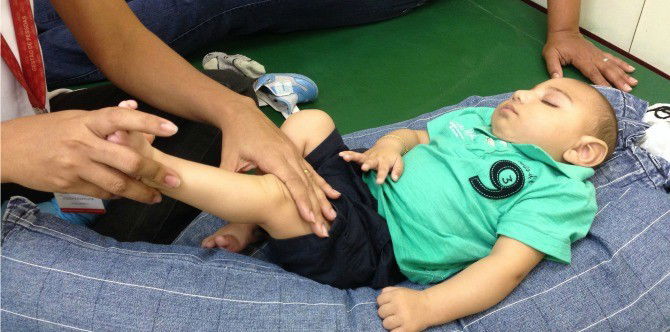 Zika can cause hearing loss along with microcephaly and heart problems in babies