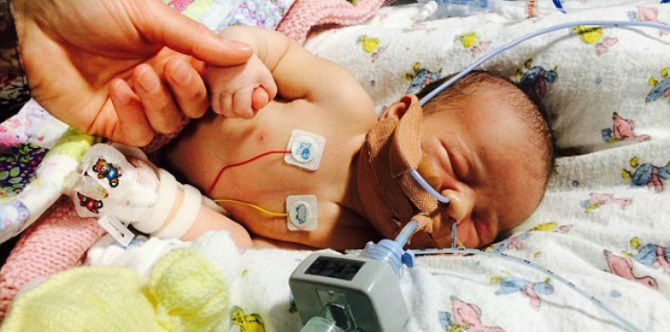 Born without a lung, toddler’s heart stapled to her ribcage to stop it from moving in her chest