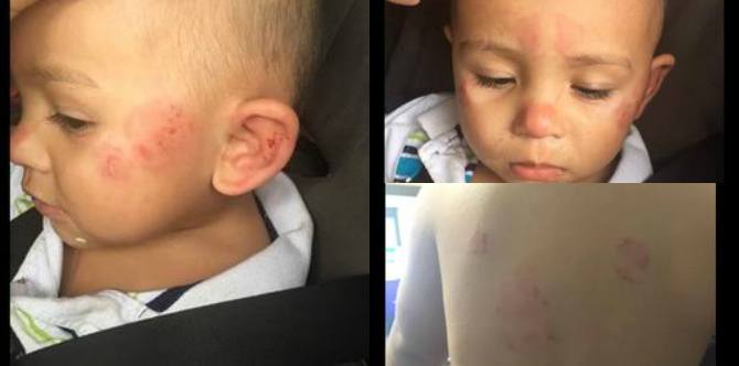 Toddler in daycare was bitten 12 times by another child