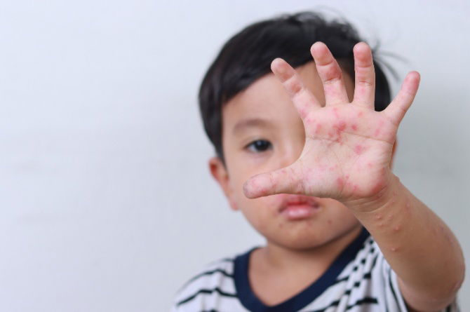 Cara Merawat HFMD Dengan Mudah, Lakukan Pencegahan Sekiranya Dijangkiti