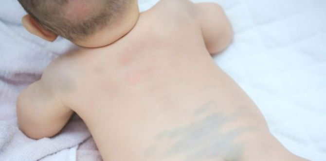 Tompokan Biru Kelabu Atau Mongolian Blue Spot Pada Bayi, Bilakah Ia Akan Hilang?