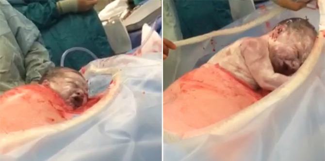 Kumpulan video persalinan caesar yang amat mengagumkan