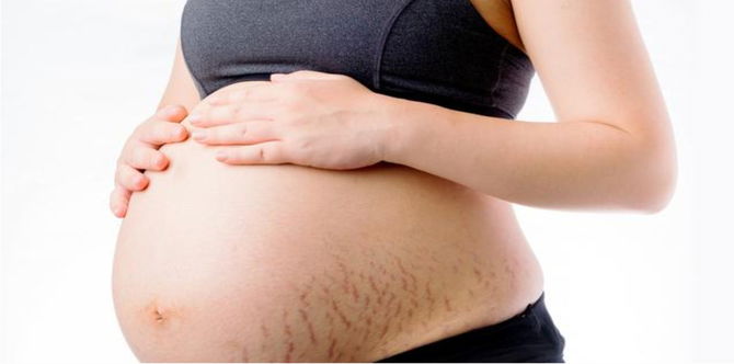 Malu Perut Penuh Stretch Mark Ketika Hamil? Ini Cara Hilangkan Stretch Mark Dengan Berkesan!