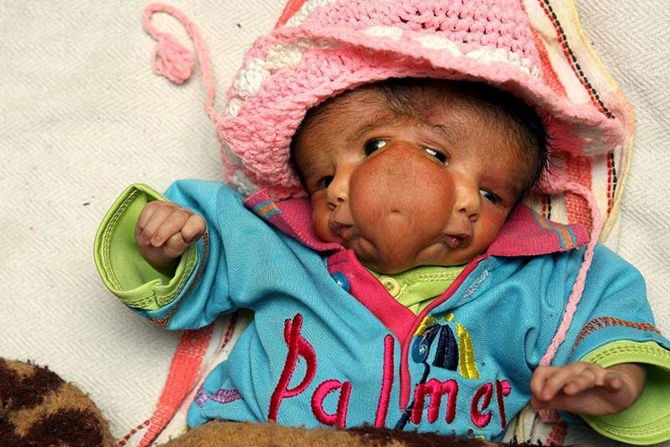 Dilahirkan Dengan Dua Wajah, Bayi Ini Dianggap Sebagai Pembawa Rezeki Hingga Ibu Bapa Enggan Rawatan!