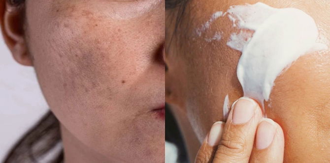Wajah Kusam & Masalah Pigmentasi? Boleh Cuba Atasinya Dengan Skincare Untuk Jeragat Terbaik Di Pasaran Ini