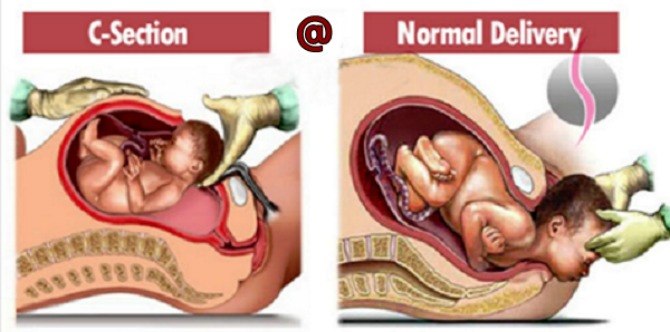 Bersalin Kembar; Normal Atau Cesarean?