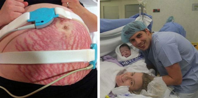 Ibu Terkejut Mengetahui Punca Ruam Ketika Hamil Yang Menyeksakan Selama Ini!