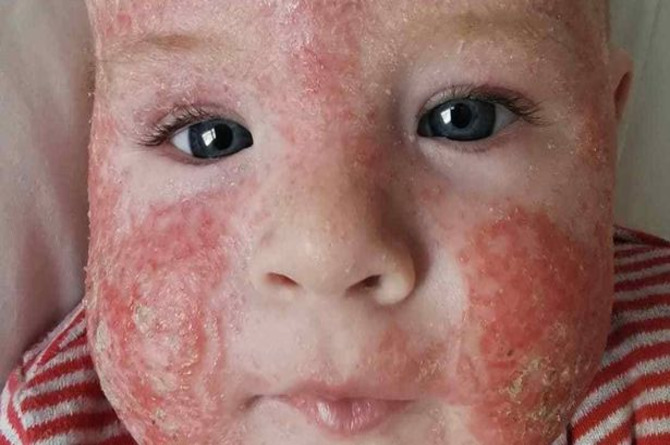 alahan susu formula, najis bayi tidak sesuai susu formula, tanda susu formula tidak sesuai dengan bayi, tanda bayi tidak sesuai susu formula