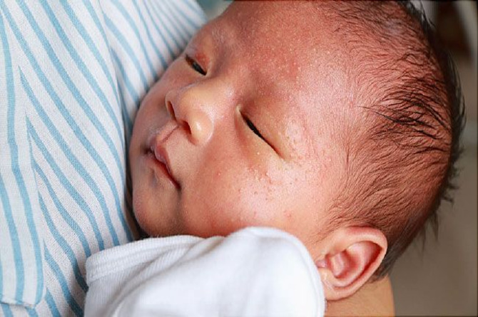 alahan susu formula, najis bayi tidak sesuai susu formula, tanda susu formula tidak sesuai dengan bayi, tanda bayi tidak sesuai susu formula