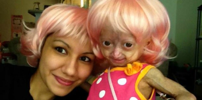 Adalia Rose, Kanak-Kanak Istimewa Dengan Penyakit Progeria, Anda Tahu Tentang Penyakit Ini?