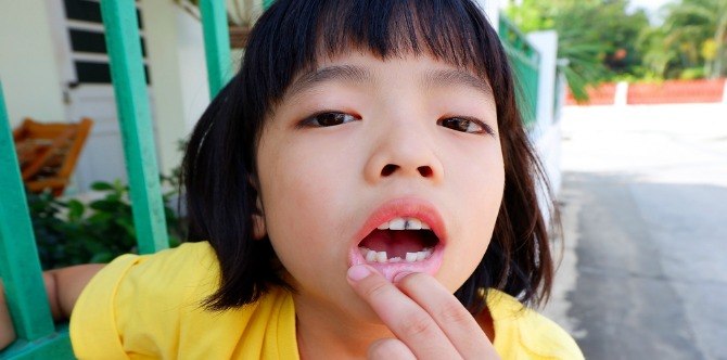 Semakin Ramai Kanak-Kanak Hilang Gigi Kerana Ibu Bapa Tidak Membawa Mereka Berjumpa Doktor Gigi