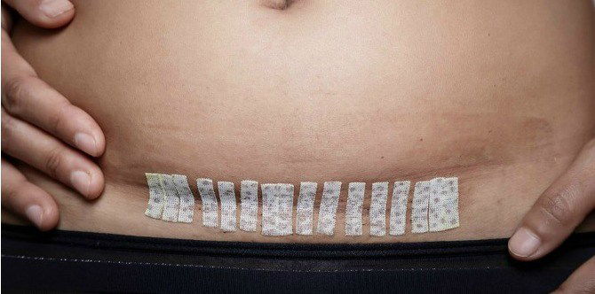 8 Tip Cara Pulih Selepas Pembedahan Caesar