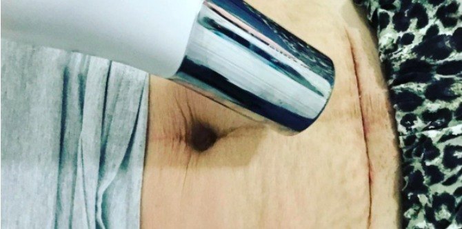 Blogger Berkongsi Gambar Parutnya Yang Radang Selepas Pembedahan Caesarean