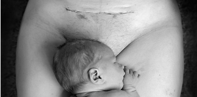 Semua Yang Anda Perlu Tahu Tentang Parut Pembedahan Caesar