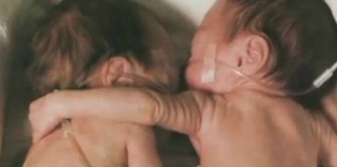 Bayi Pramatang Bertarung Nyawa Berjaya Diselamatkan Oleh Kembarnya