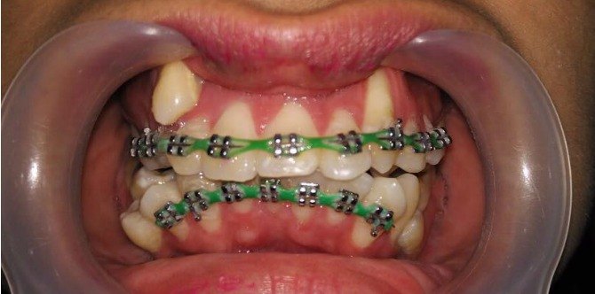 Fake Braces Berbahaya! Jauhi "Doktor" Gigi Yang Pasang Pendakap Gigi Haram