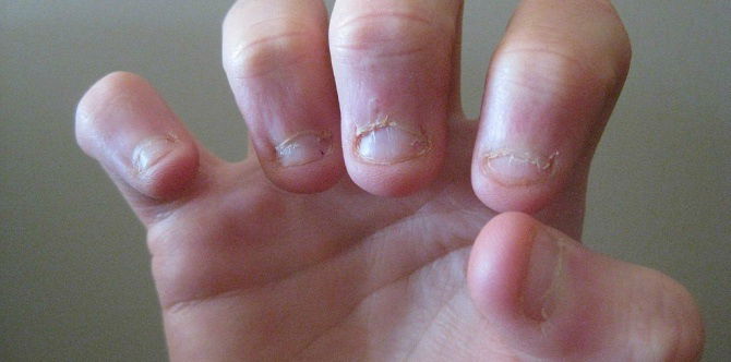 4 Jangkitan Serius Dan Berbahaya Apabila Anak Selalu Gigit Kuku