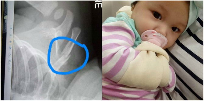 Bayi Jatuh Katil Patah Tulang Kolar, Jangan Ambil Mudah Kalau Bayi Terjatuh!