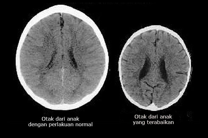 Lihat Perbezaan Otak Anak Yang Terima Cukup Kasih Sayang Dan Tidak Cukup