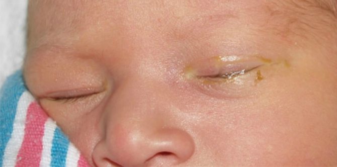 Apa Yang Boleh Sebabkan Saluran Air Mata Bayi Tersekat Dan Cara Rawatannya?