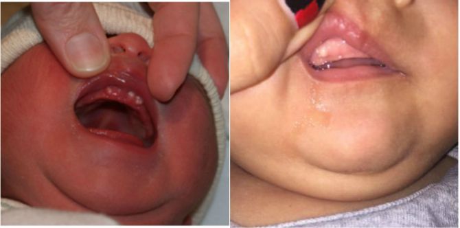 Ada Benjolan Atau Bintik Putih Pada Gusi Bayi, Perlukah Saya Risau?