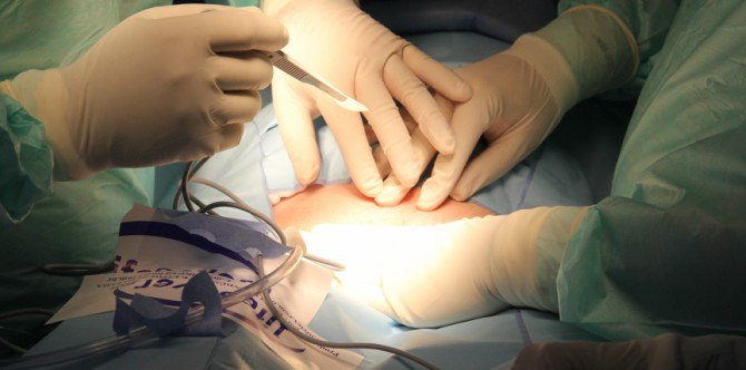 Semua Yang Anda Patut Tahu Tentang Penjagaan Lepas C-Section