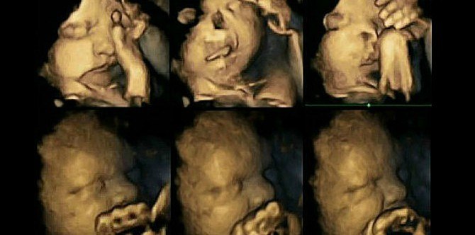 Gambar Ultrasound 4D Ini Menunjukkan Kesan Rokok Pada Janin