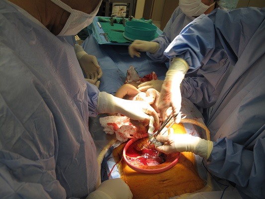 src=https://my admin.theasianparent.com/wp content/uploads/sites/6/2018/01/Caesarean section operation  cutting the umbilical cord 8Feb2011.jpg Bayi maut selepas doktor tak sengaja terpotong kepalanya ketika C section