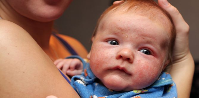 10 Jenis Gelembung Air Pada Kulit Bayi Yang TIDAK PATUT Dibiarkan, Ia BAHAYA!