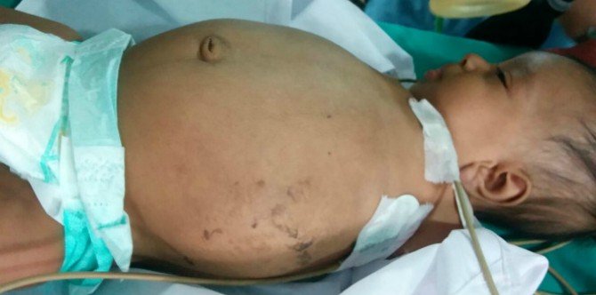 Doktor Ingat Penyakit Tumor Pada Perut Bayi, Rupanya Ia Adalah Kembar Bayi Tersebut!
