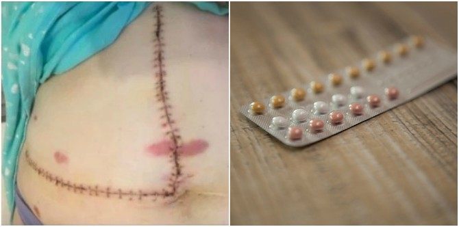 Inilah kesan ambil pil perancang dalam jangka masa panjang yang ramai wanita tak sedar!