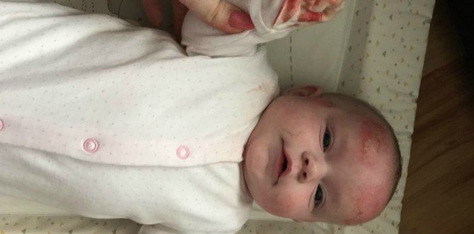 Ibu ini sembuhkan ekzema pada bayinya dengan krim semulajadi yang berkesan!