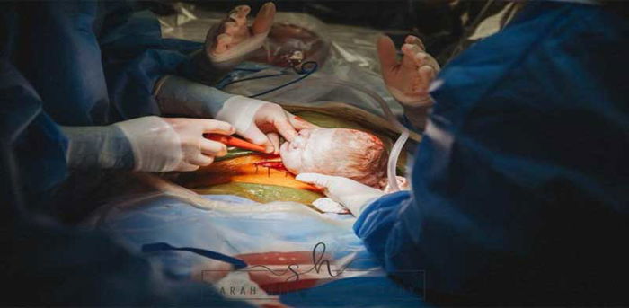 Wanita hebat ini keluarkan anaknya sendiri dari perut semasa pembedahan C-Section!